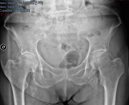 radiografia anca
