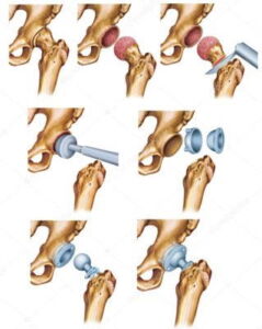 illustrazione fasi di intervento