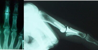 Controllo radiografico a 6 mesi.