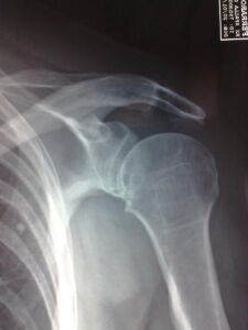 radiografia di acromion