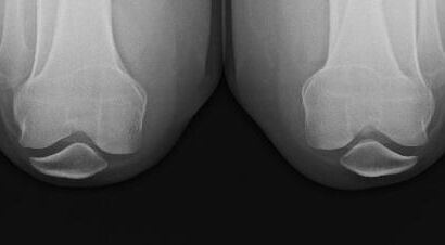 radiografia in posizione flessa