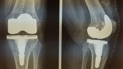 Protesi della tibia.