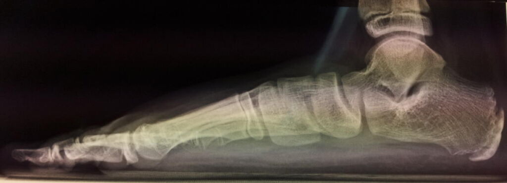 radiografia piede piatto