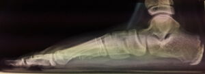 radiografia piede piatto