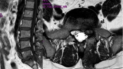 rmn di vertebra scivolata indietro