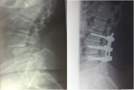 spondilolistesi radiografia post intervento