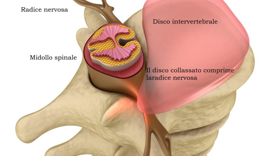 illustrazione disco lombare