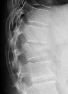 fratture vertebrali radiografia