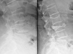 frattura 3a vertebra lombare