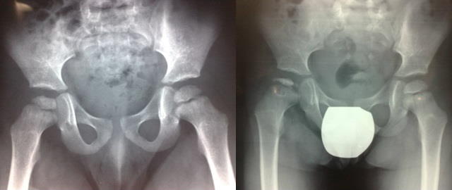 radiografia anca bambino