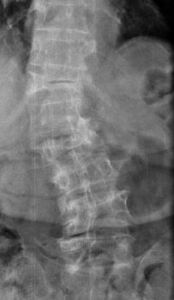 radiografia scoliosi adulto