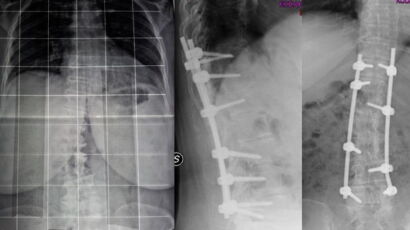 correzione con stabilizzazione