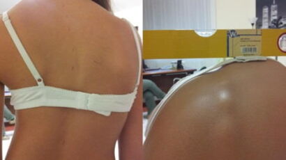 misurazione angolazione scoliosi donna