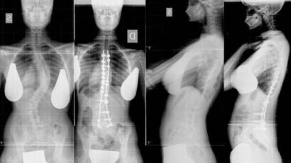 radiografia scoliosi pre e post trattamento