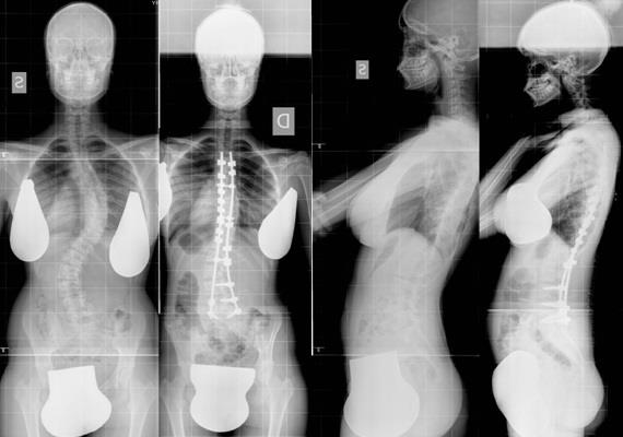 radiografia scoliosi pre e post trattamento