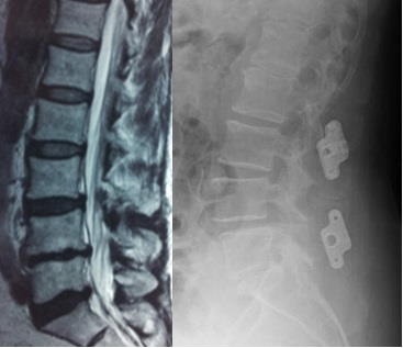 impinto interspinoso