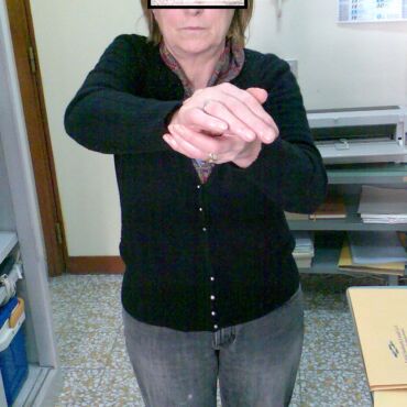 conflitto subacromiale