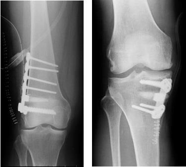radiografia osteotomia ginocchio