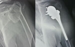 radiografia per e post intervento
