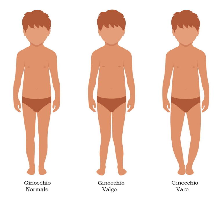 ginocchio varo/valgo