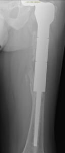 radiografia impianto di megaprotesi