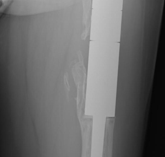 radiografia impianto di megaprotesi