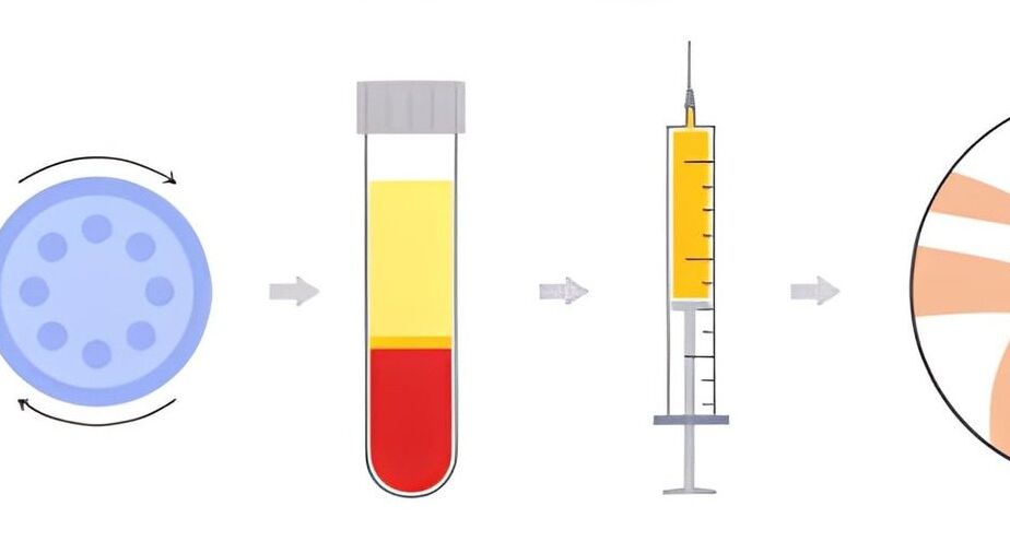 prelievo di sangue e creazione del surnante