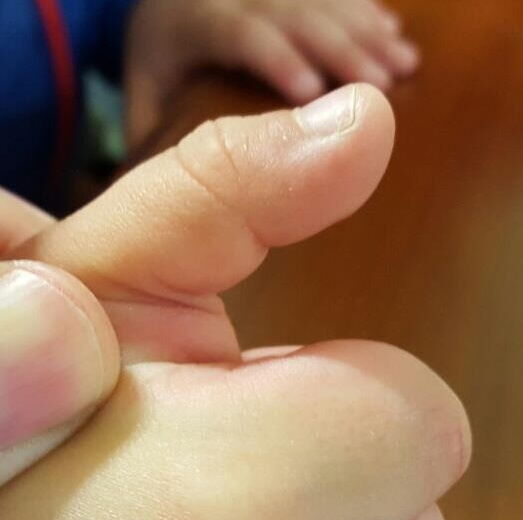 dito a scatto nel bambino