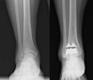 radiografia protesi di caviglia
