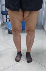 caso 3 protesi ginocchio