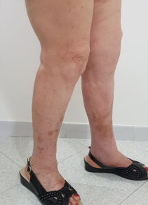 caso 7 protesi di ginocchio