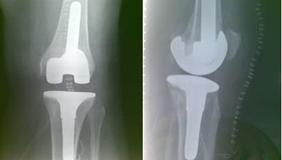 revisione protesi radiografia