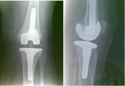 revisione protesi radiografia