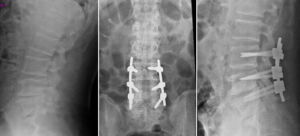 stenosi lombare quadro radiografico
