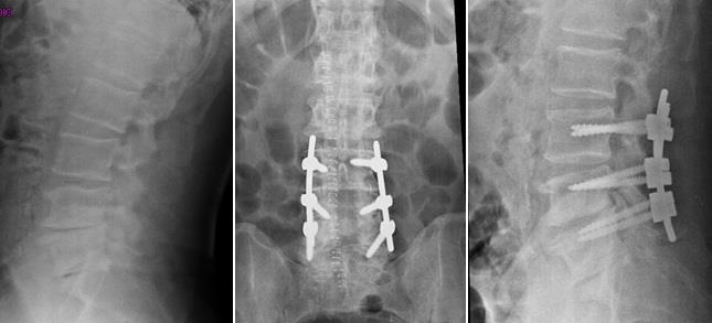 stenosi lombare quadro radiografico