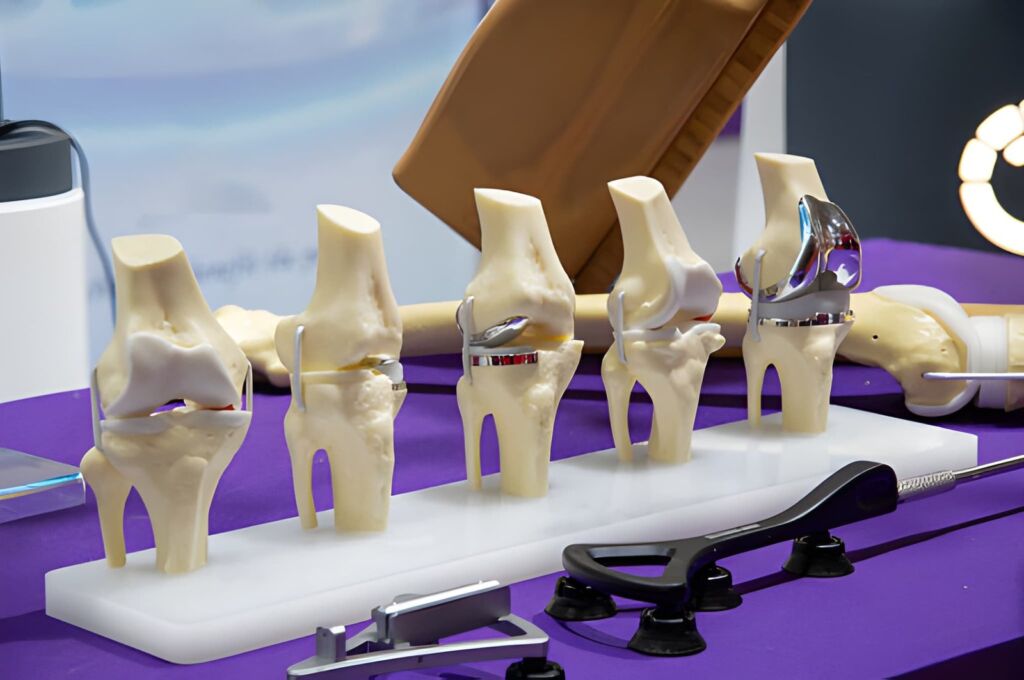 Protesi di ginocchio: monocompartimentale o totale? La guida per scegliere