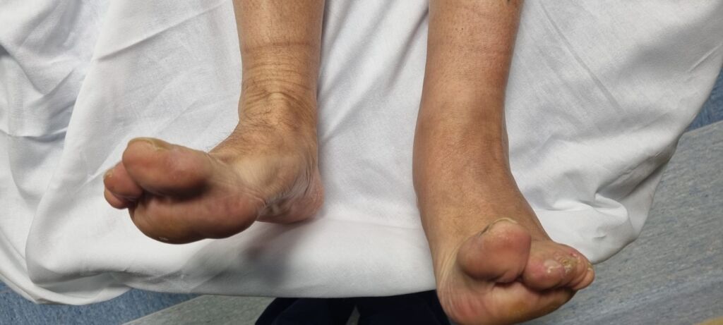 Piede cadente dopo una protesi d’anca: cause, diagnosi e possibili trattamenti