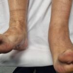 Piede cadente dopo una protesi d’anca: cause, diagnosi e possibili trattamenti