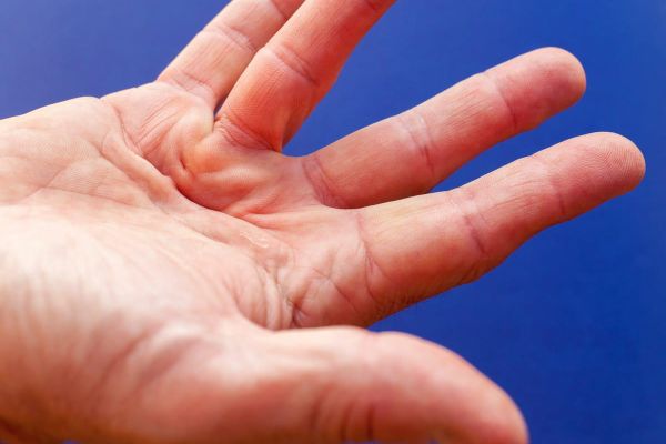 La malattia di Dupuytren con tecnica mini-invasiva