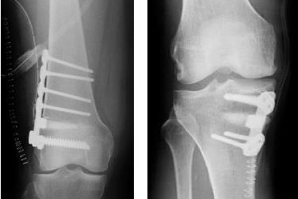 radiografia osteotomia ginocchio