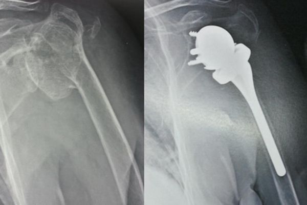 radiografia per e post intervento