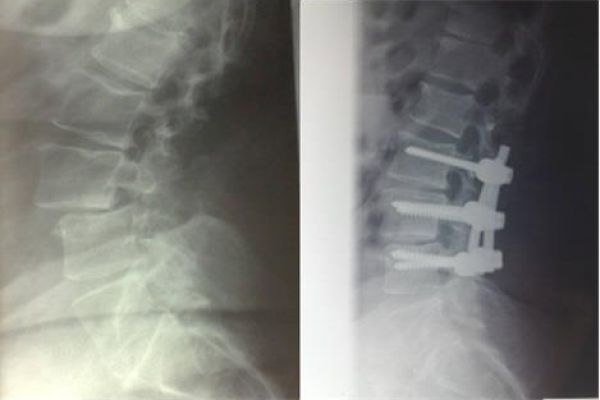 spondilolistesi radiografia post intervento