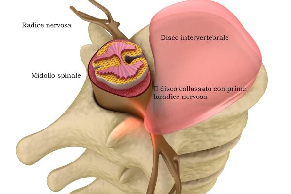 illustrazione disco lombare