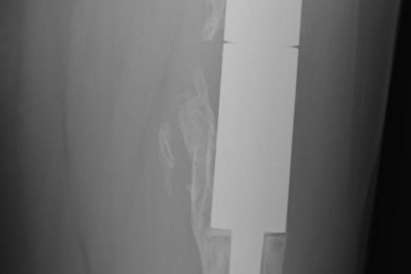 radiografia impianto di megaprotesi