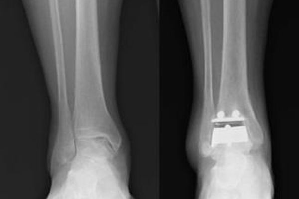 radiografia protesi di caviglia