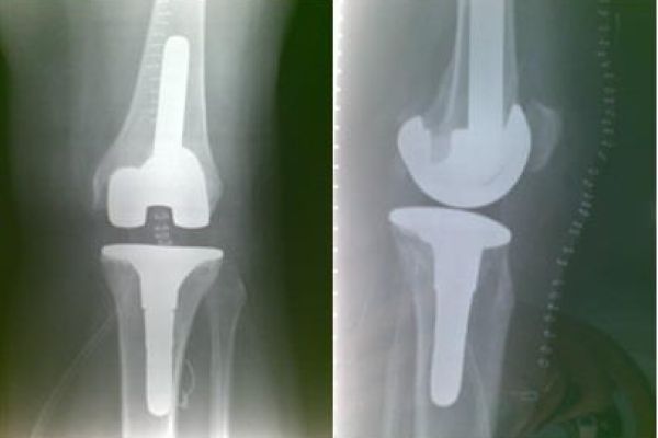 revisione protesi radiografia