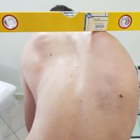 bending test scoliosi