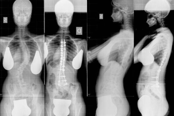 radiografia scoliosi pre e post trattamento