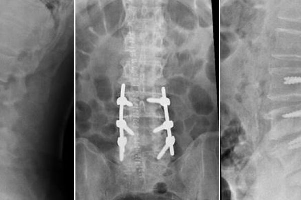 stenosi lombare quadro radiografico